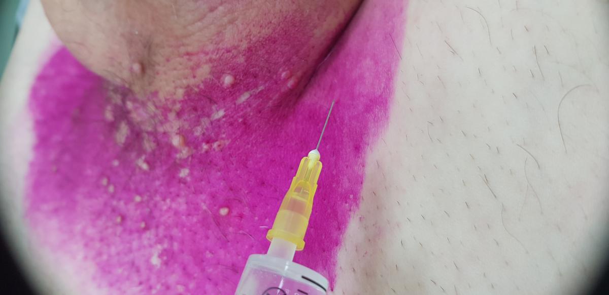 лимфотропная терапия лимфотропка