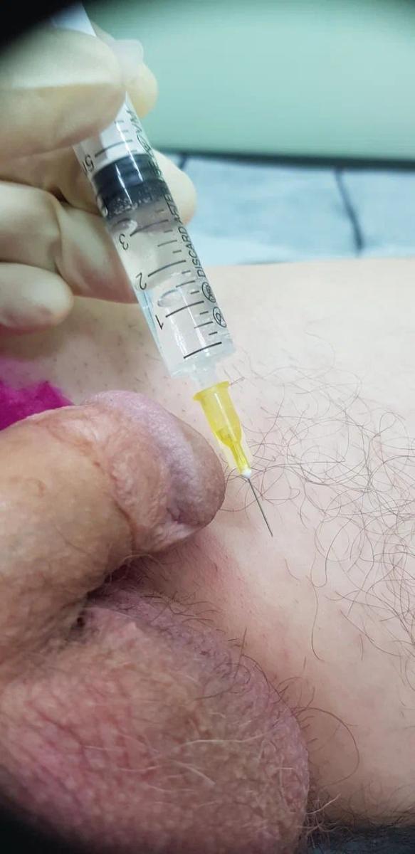 Лимфотропное введение