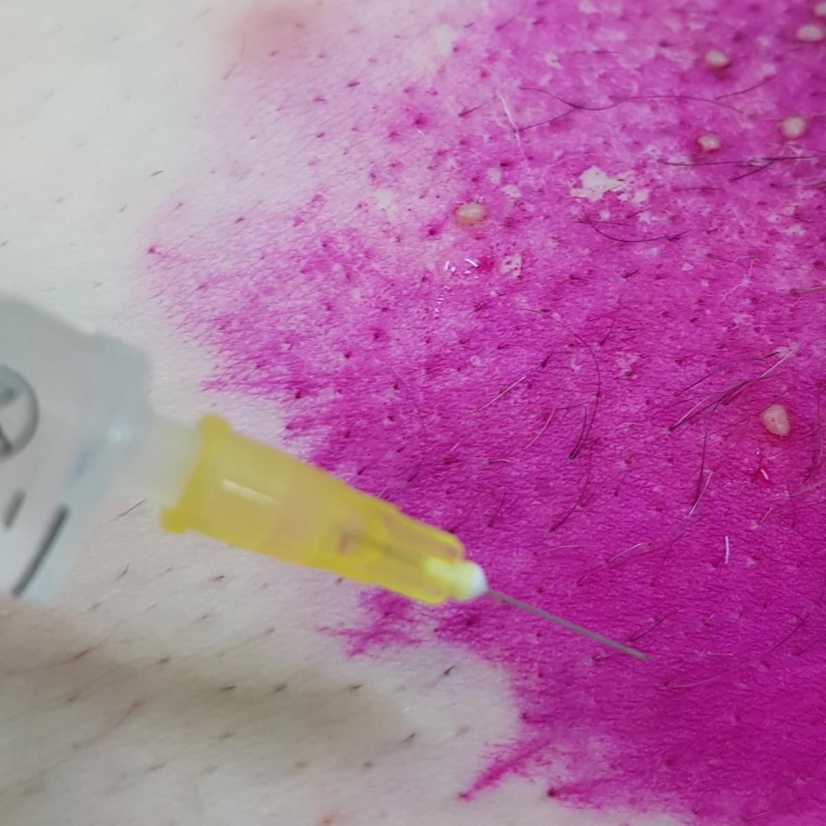 Лимфотропная инъекция Лимфотропное введение лекарственных препаратов