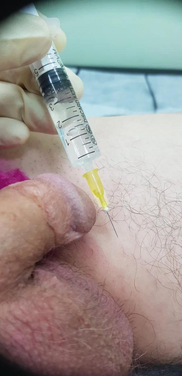 лимфотропное введение антибиотиков