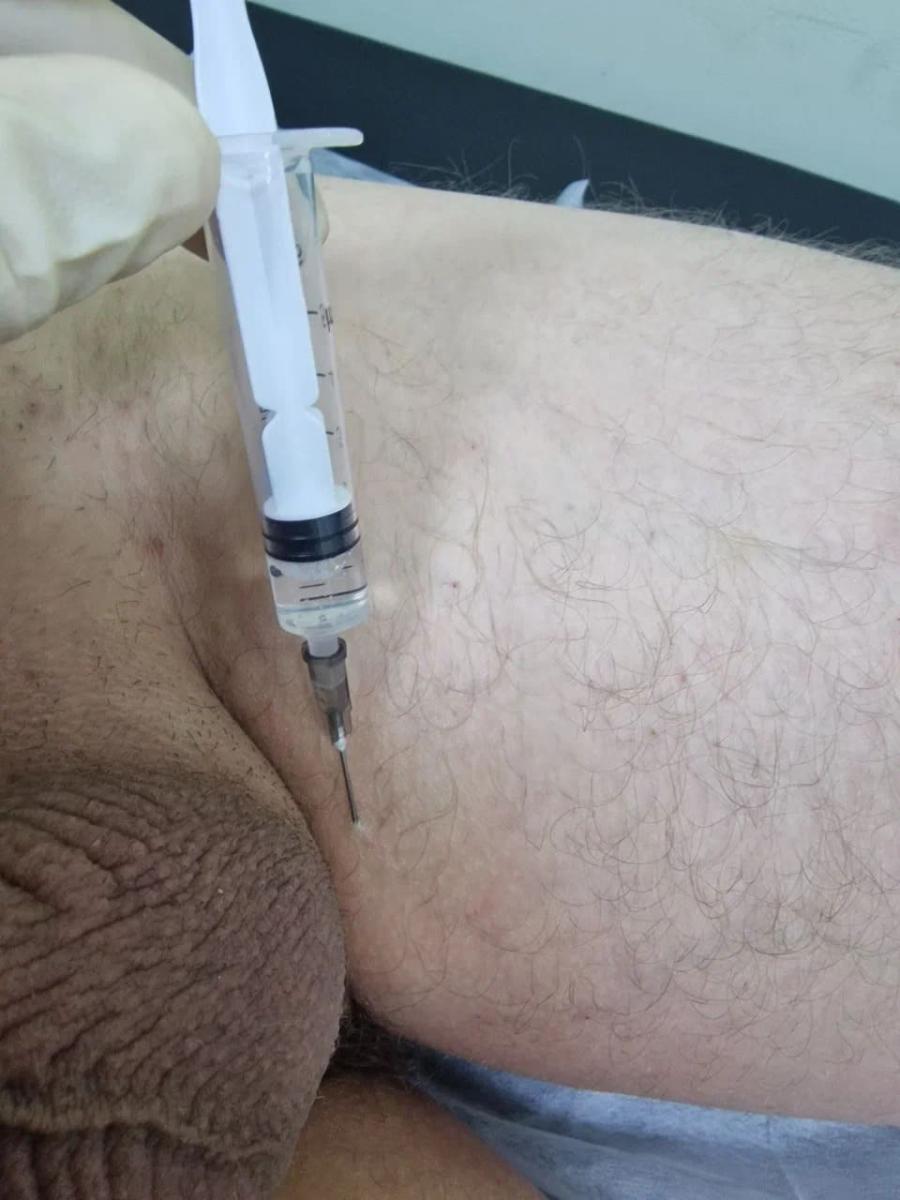 Электрофорез