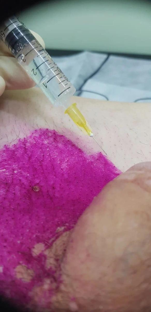 Лимфотропное введение