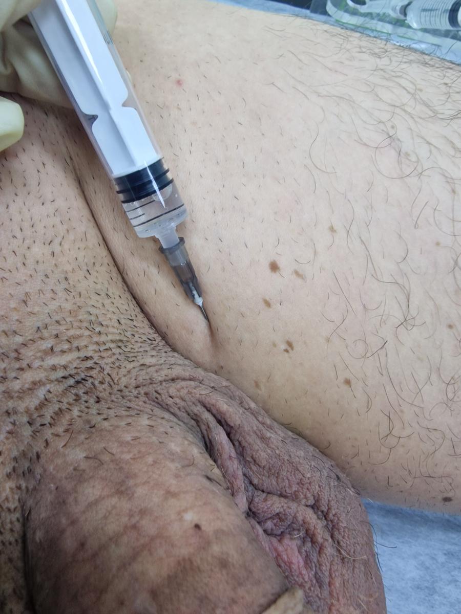 Лимфотропное введение антибиотиков