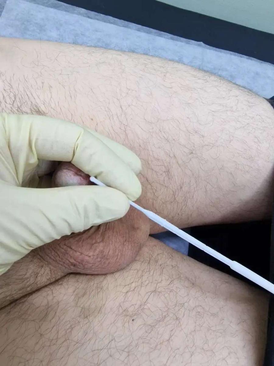 взятие мазка из уретры взятие мазка из уретры