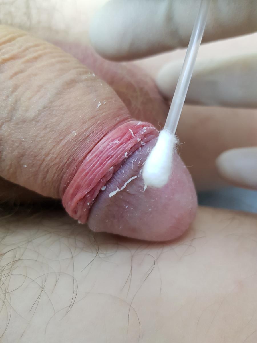 соскоб с головки члена соскоб