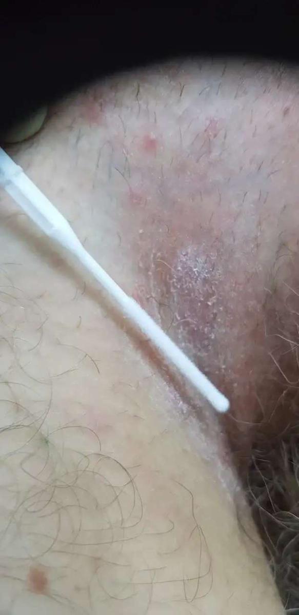 микоз паховых складок микоз паховых складок