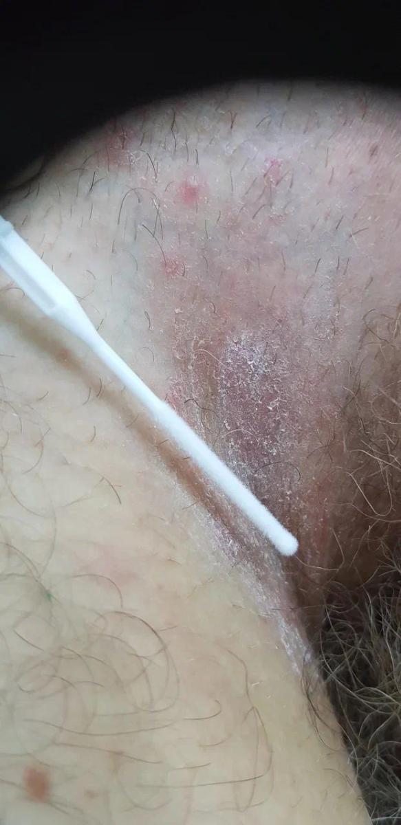 микоз паховых складок
