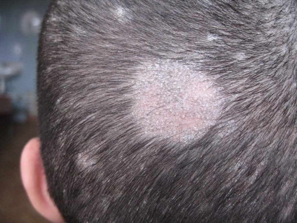 грибок волосистой части головы