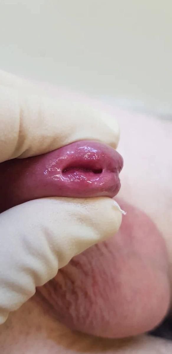 заражение гарднереллой мужчины