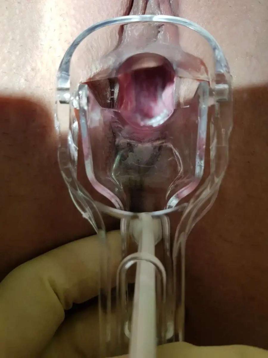 соскоб на инфекции молочница