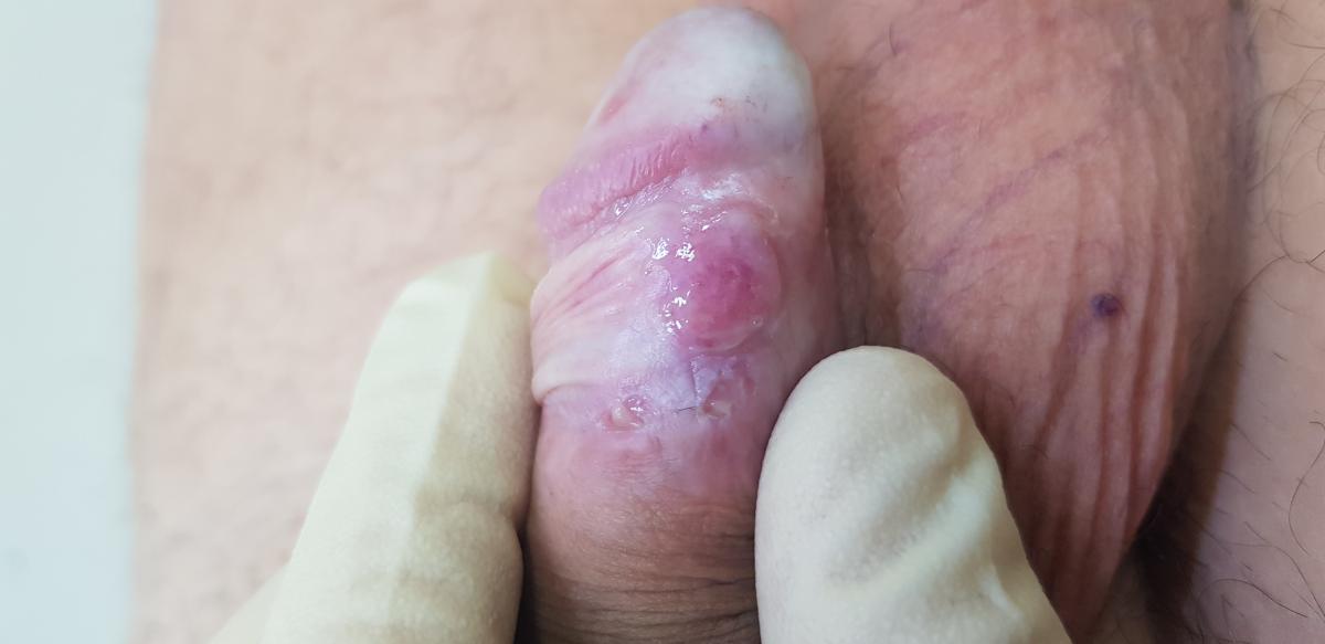 Реакция Вассермана Реакция Вассермана позволяет определить болен ли человек