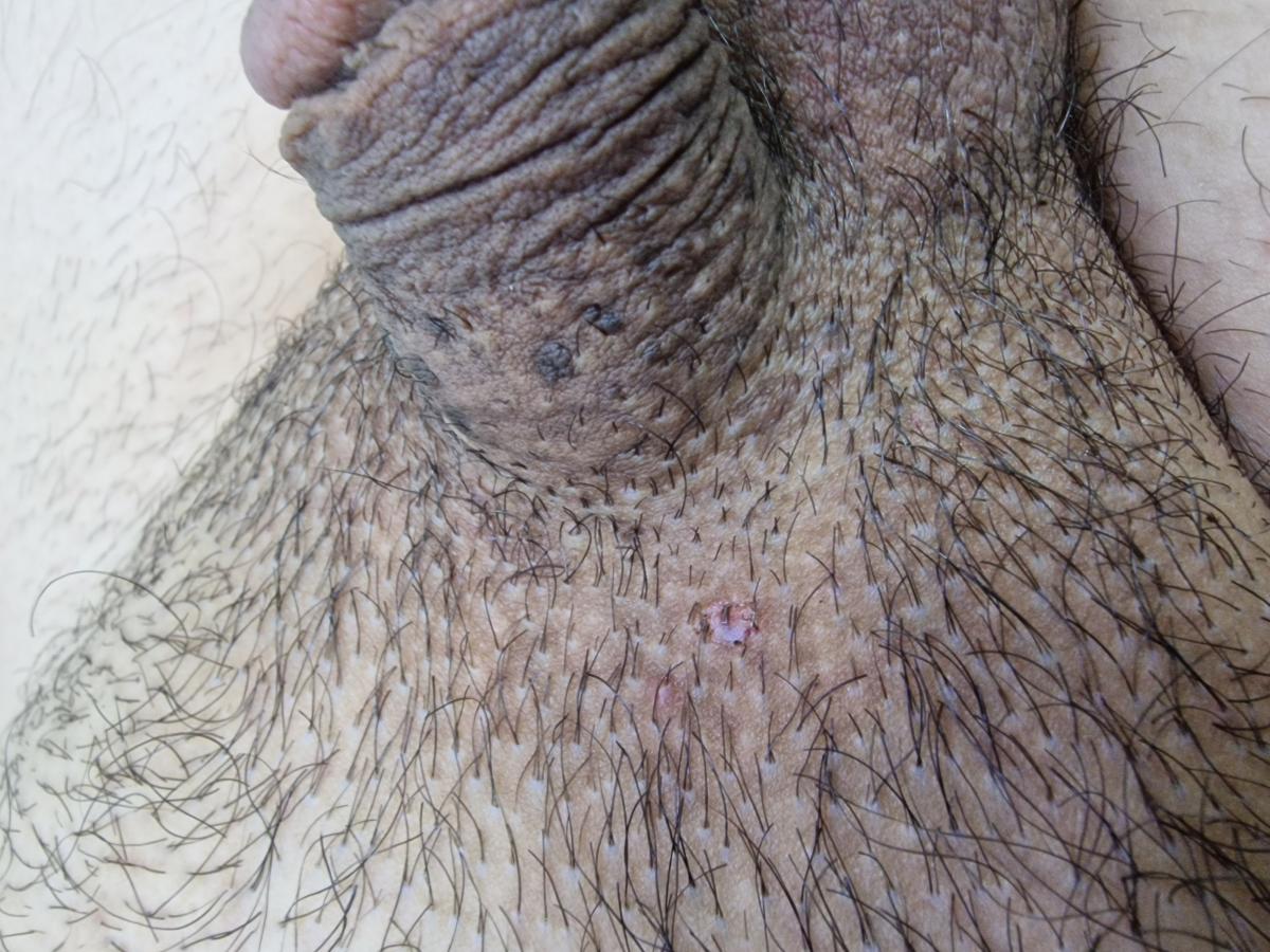 начало удаления черных бородавок в основании члена начало удаления