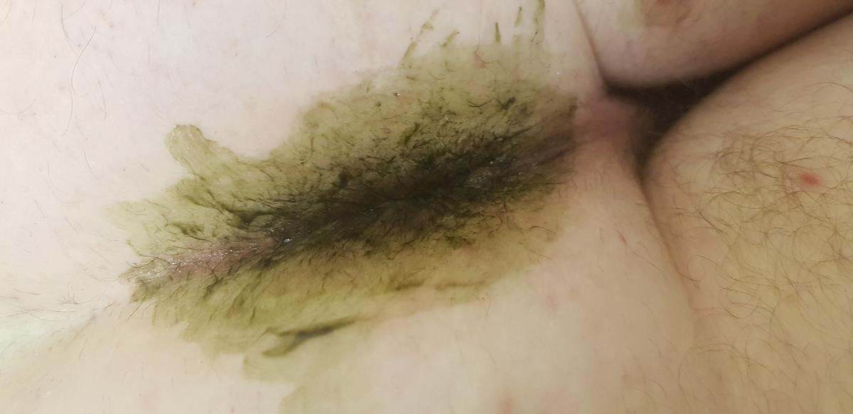 фотодинамическая 