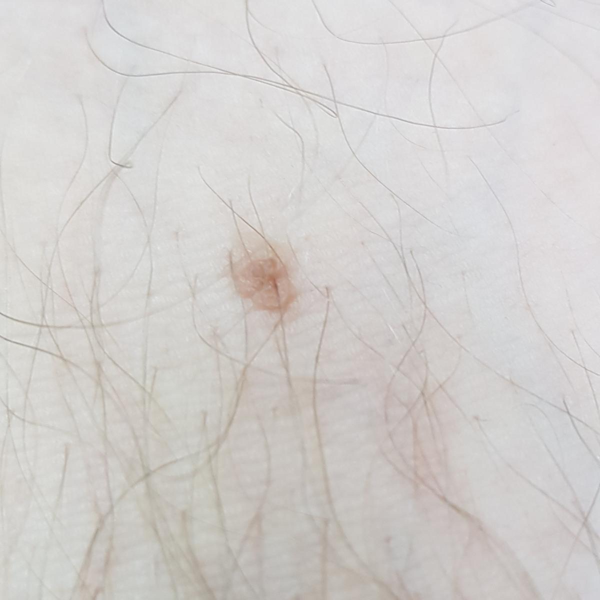 родинока на предплечии