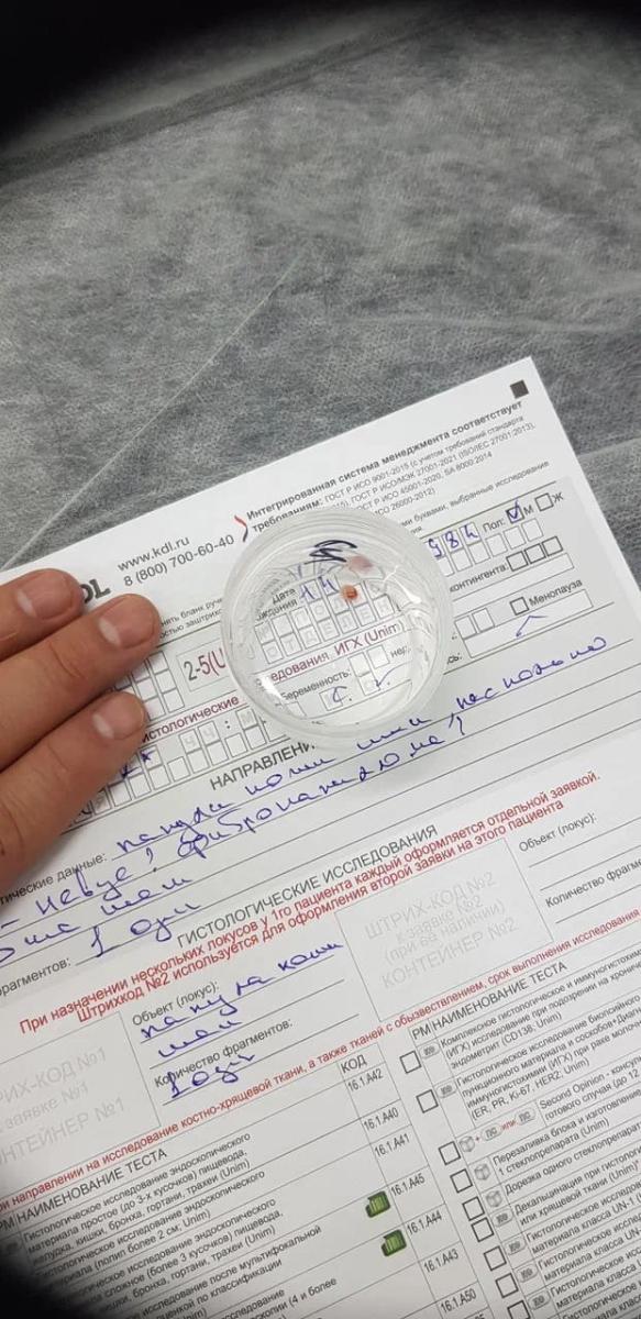 гигантская анальная кондилома Гистологическое исследование биопсийного материала