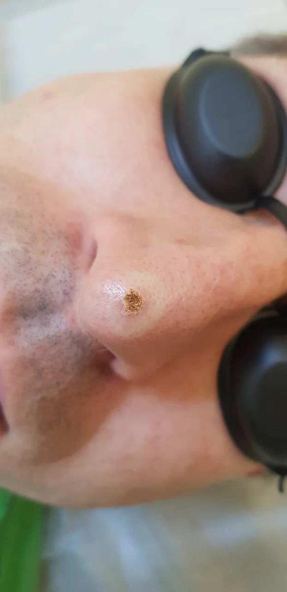 бородавки после самолечения