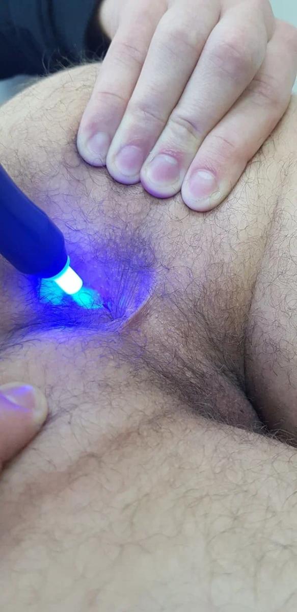 Обработка оксидом азота