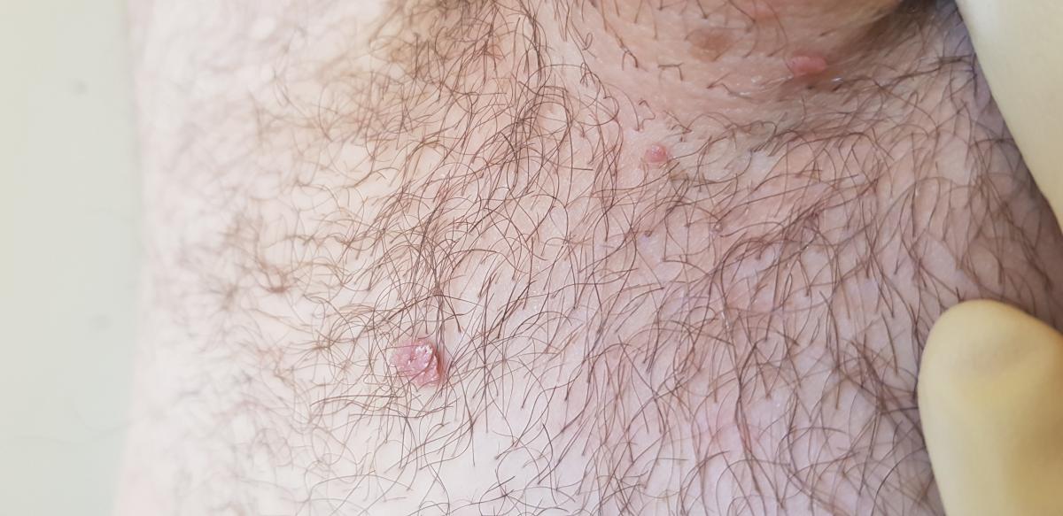 папилломы на лобке