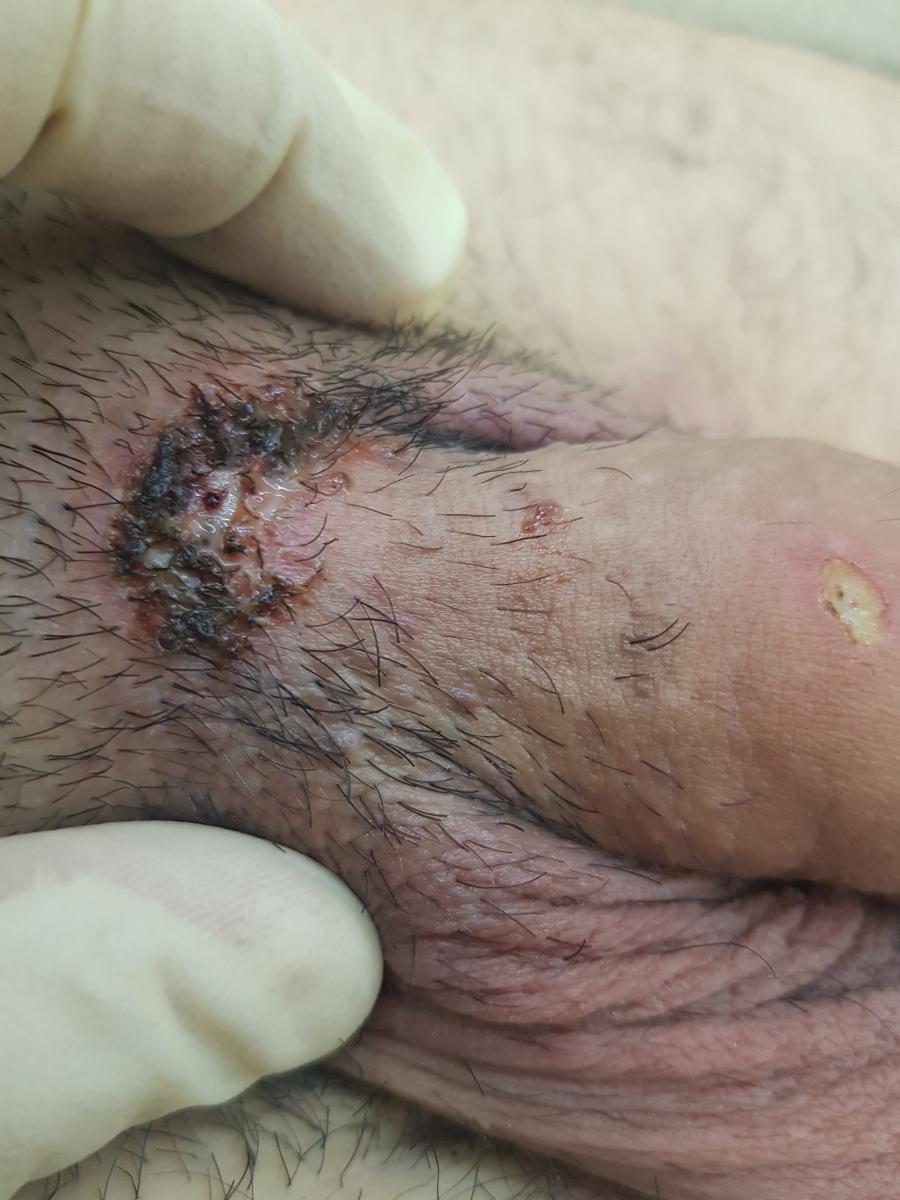 отек и гной