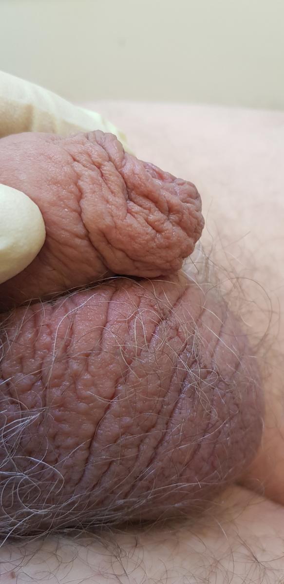 Отек мошонки