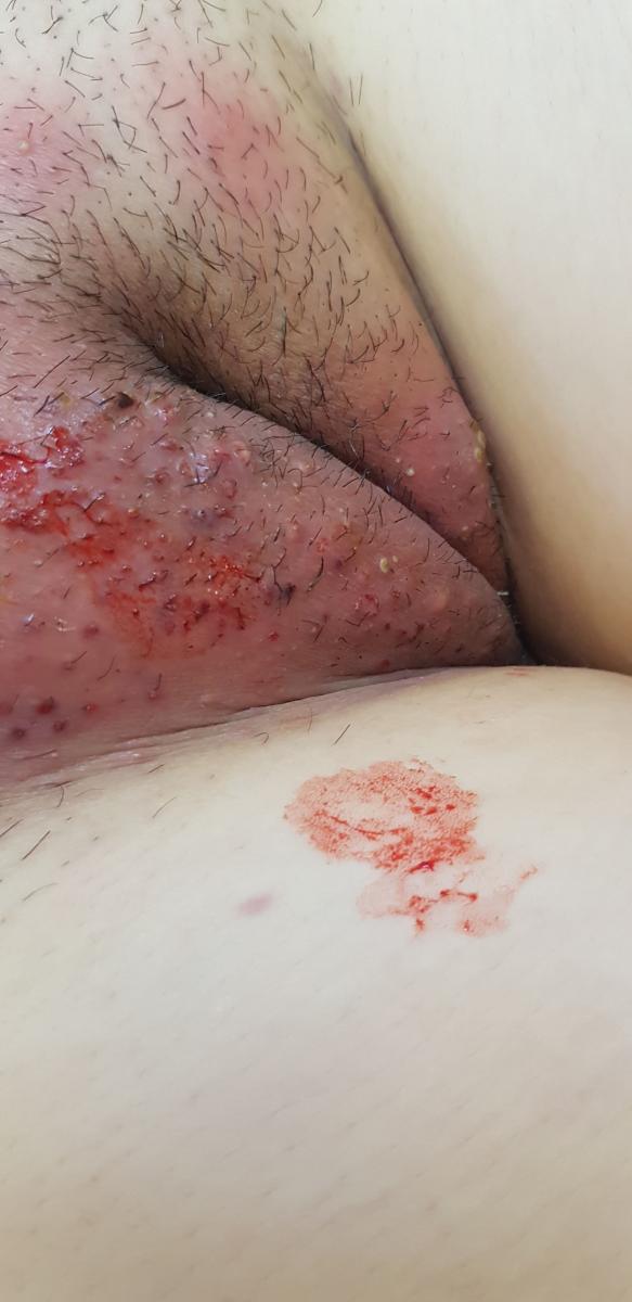 Аллергический отек и герпес половых губ