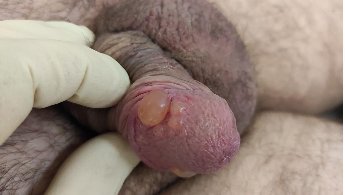 отек при травме