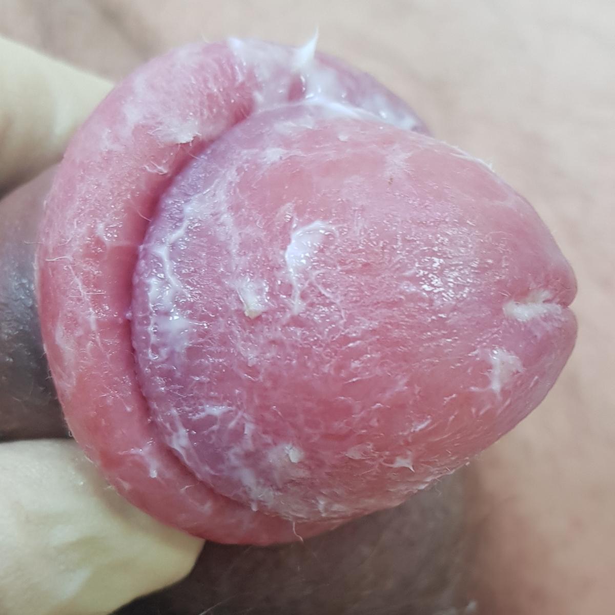 парафимоз вправление парафимоза