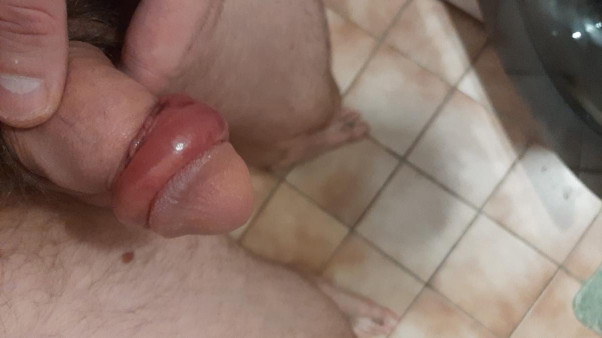 Фимоз полового члена