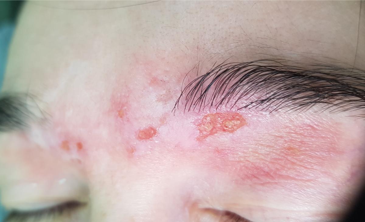 облысение бровей при сифилисе