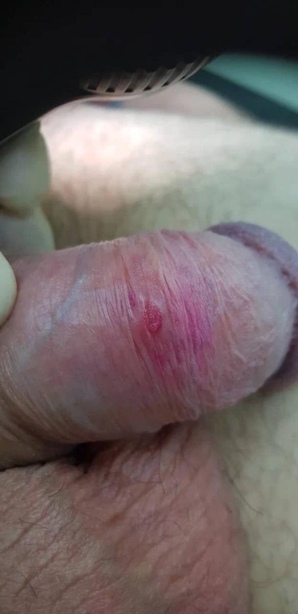 первичный микрошанкр на плоти, трепонема пцр положительная