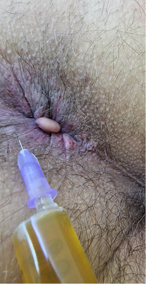 плазмолифтинг