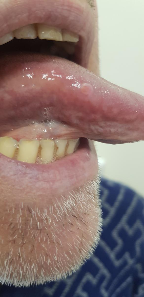 кондилома на языке