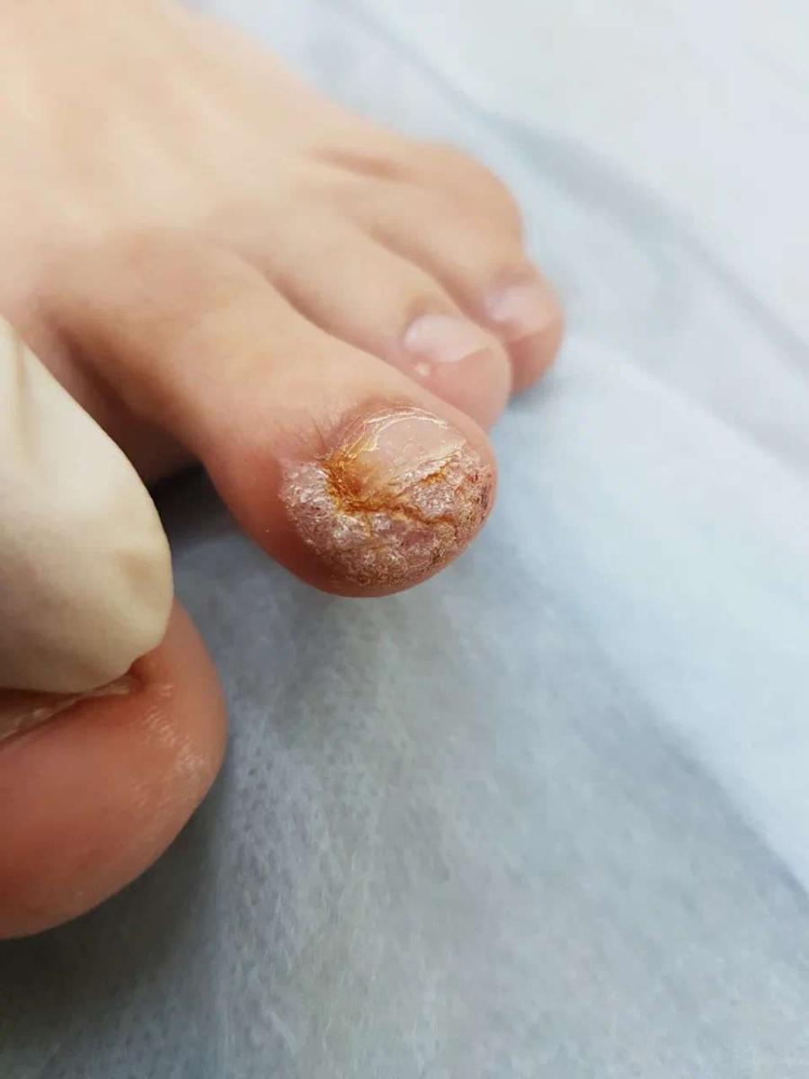 рецидивирующие бородавки