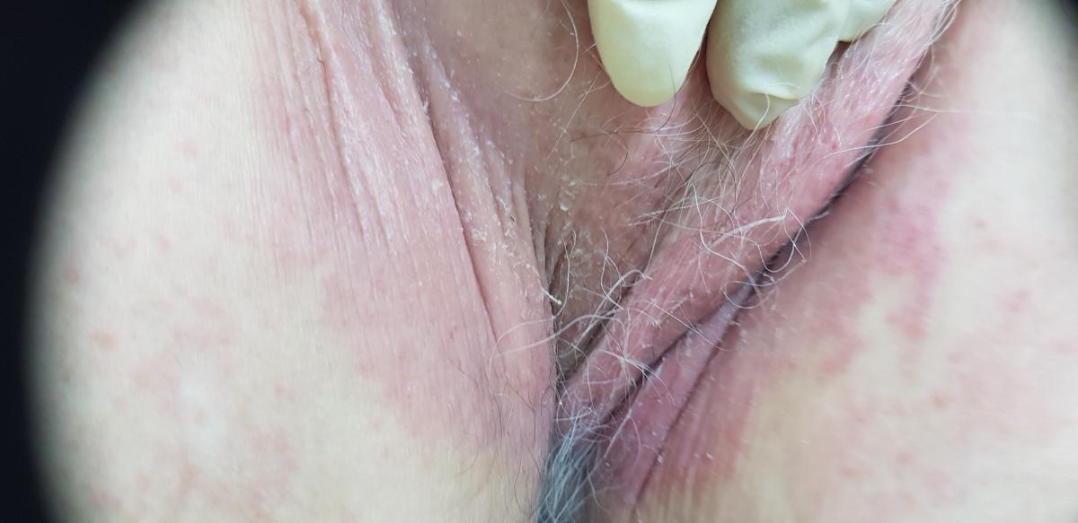 зуд кожи лобка зуд при герпесе