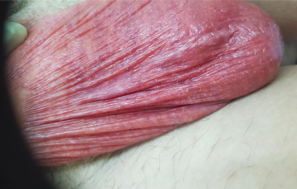 эпидидимит покраснение мошонки