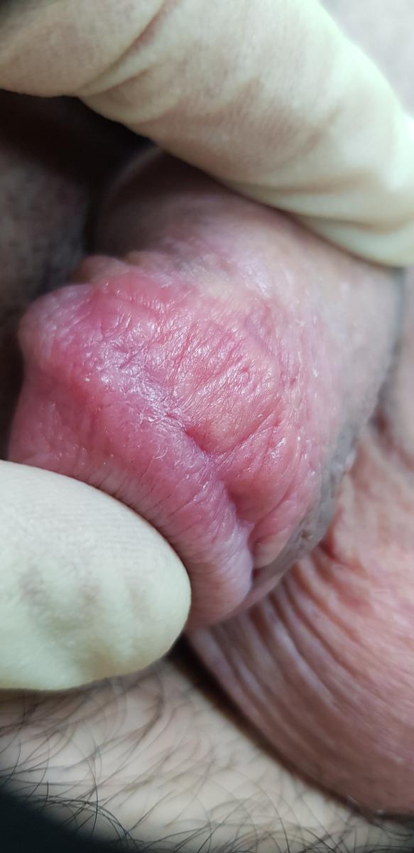 псориаз псориаз