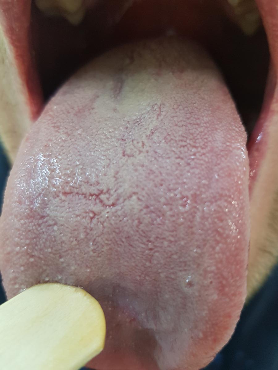 черный язык после лечения