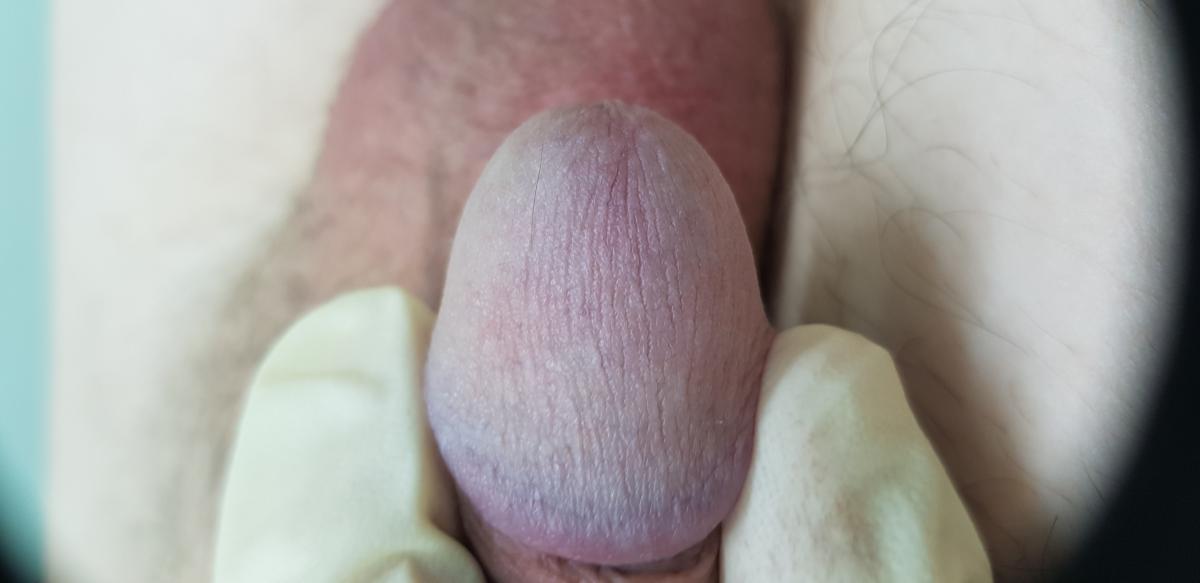 после лечения хронического баланопостита после лечения