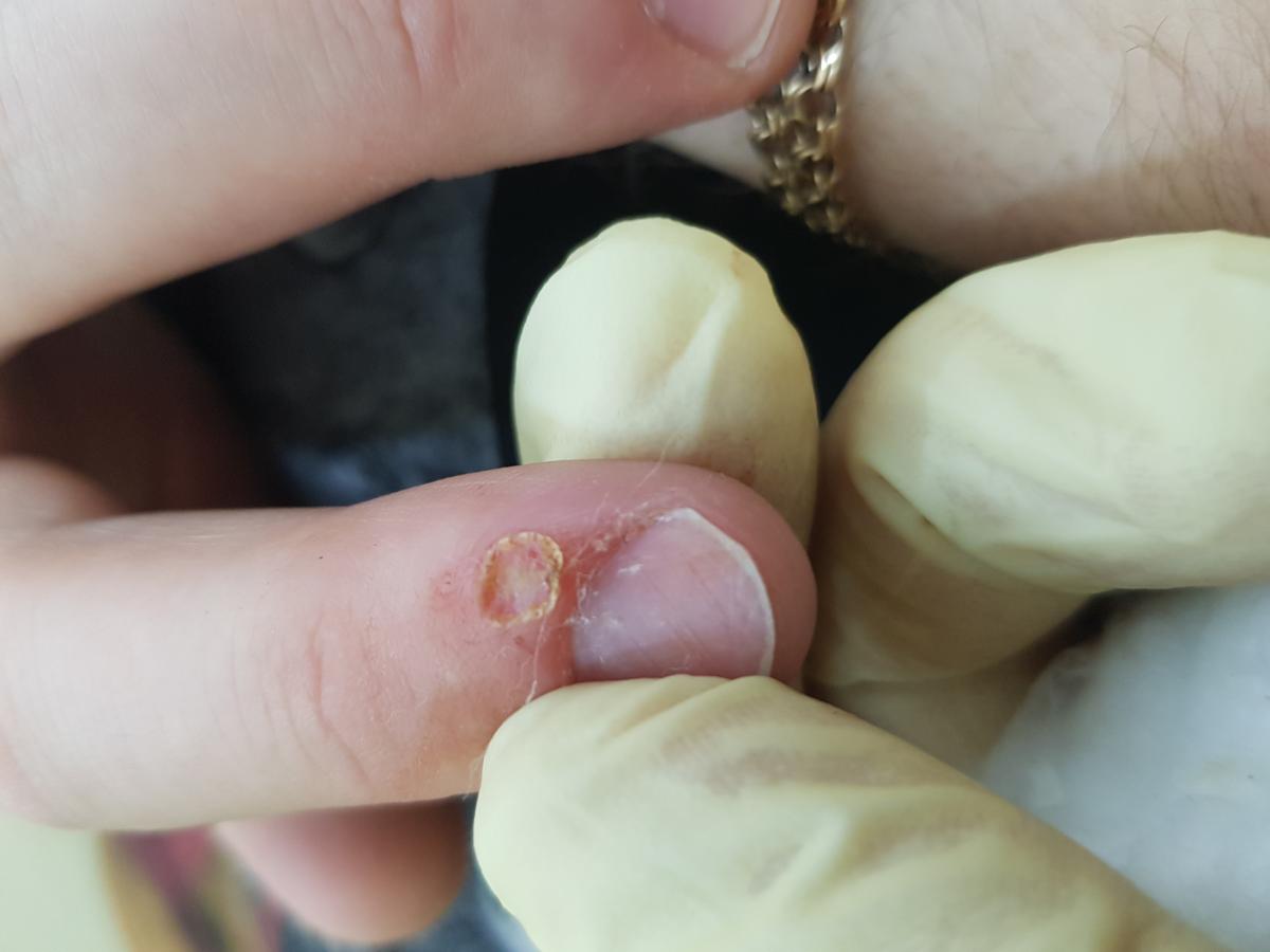 после удаления бородавок на пальцах кистей после удаления