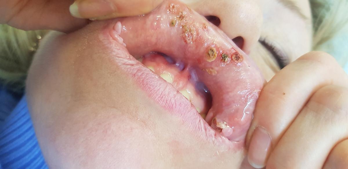 после удаления бородавок во рту электрокоагулятор