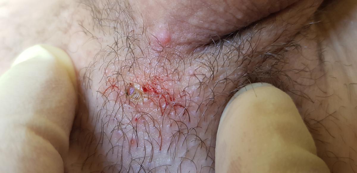 после удаления узелков в основании члена удаление узелков