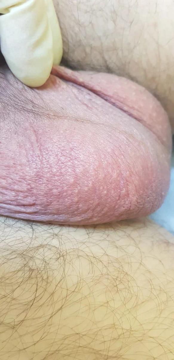 правосторонний эпидидимит при герпесе и впч