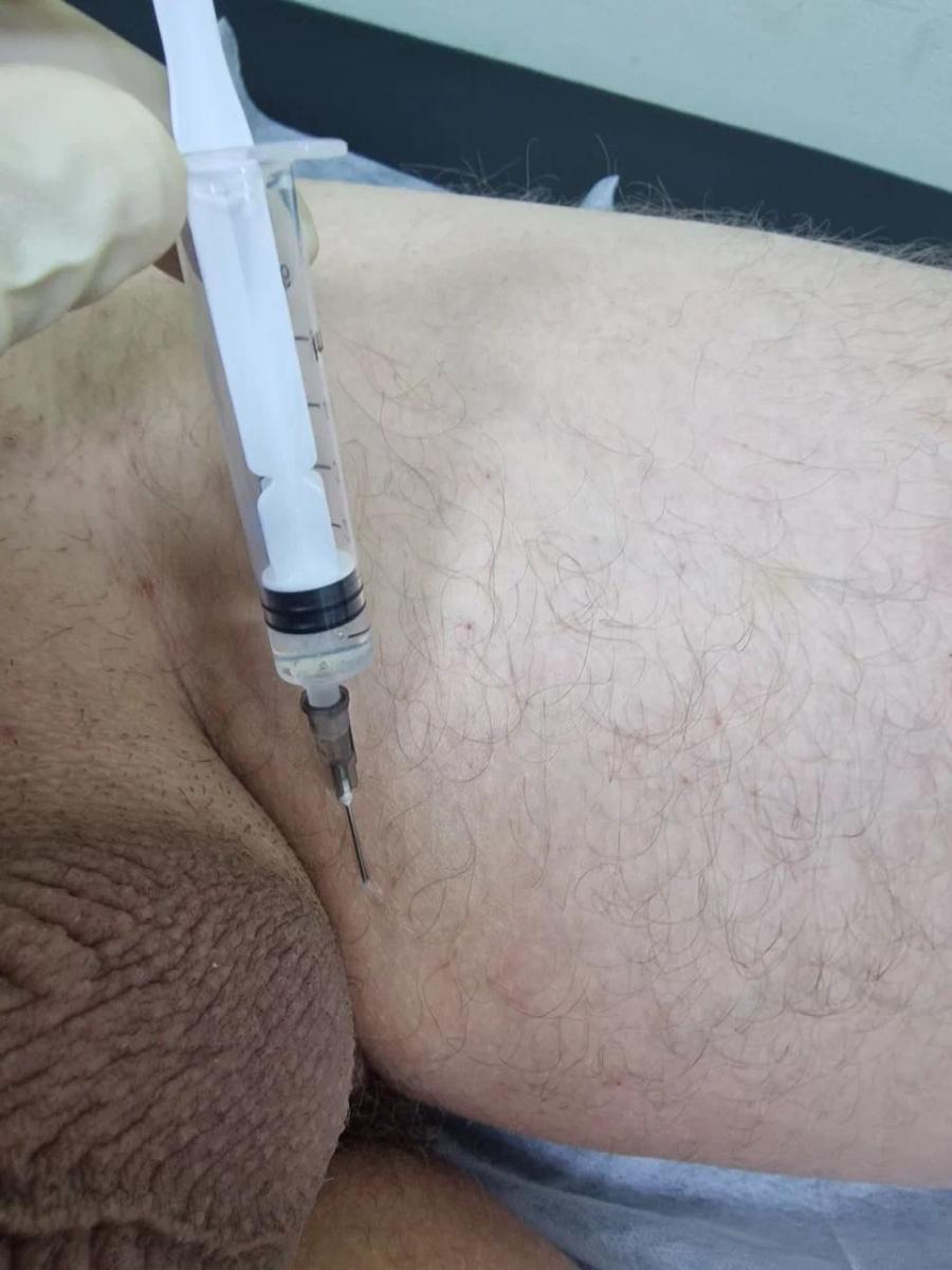 Лимфотропное введение