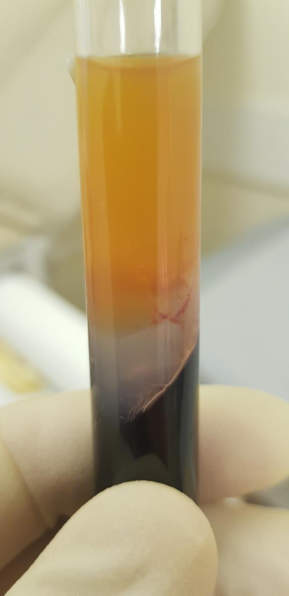 плазмалифтинг при зуде ануса пробирка с плазмой крови