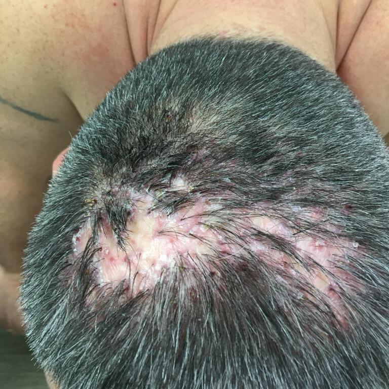 псевдопелада брока