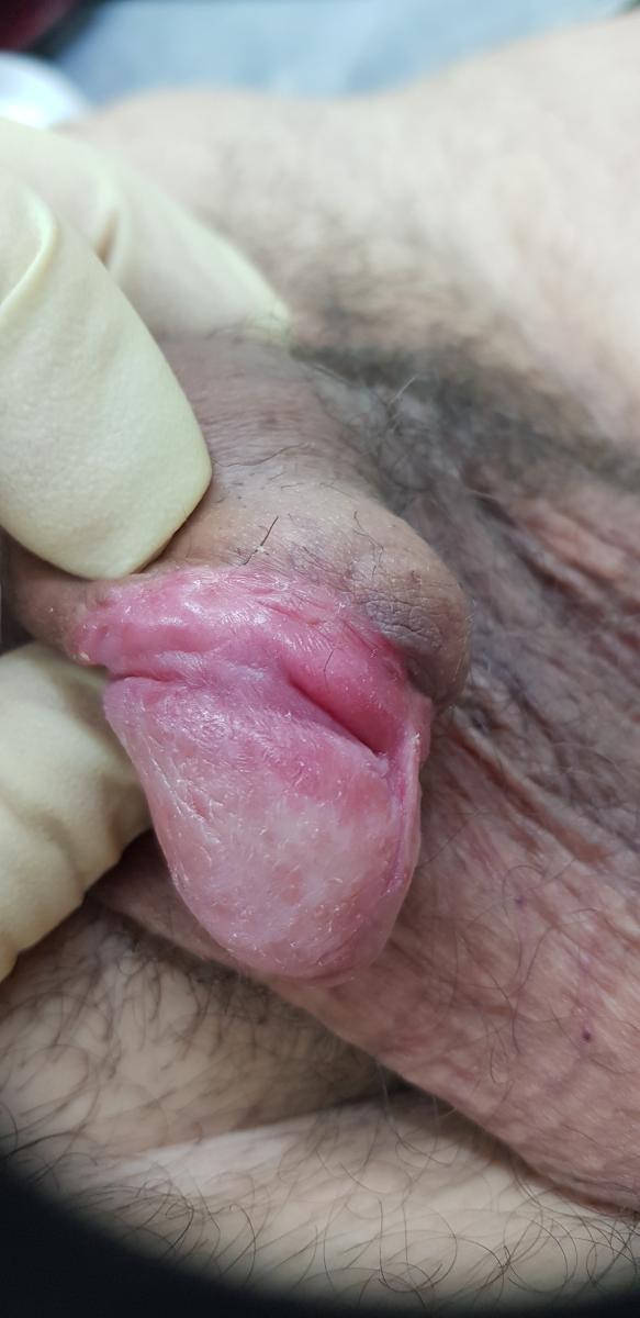 Генетическая предрасположенность Генетическая обусловленность псориаза