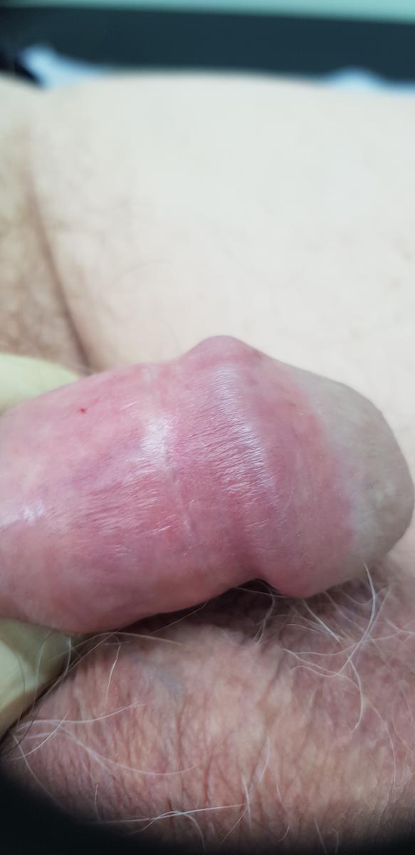 псориаз головки