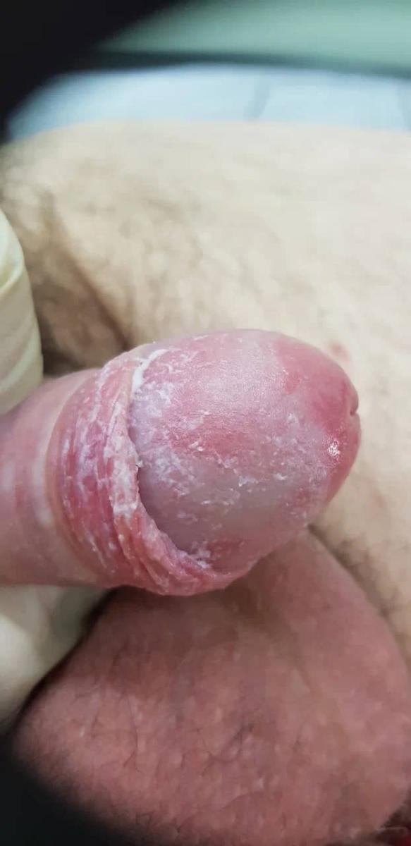 Образование белых творожистых налетов