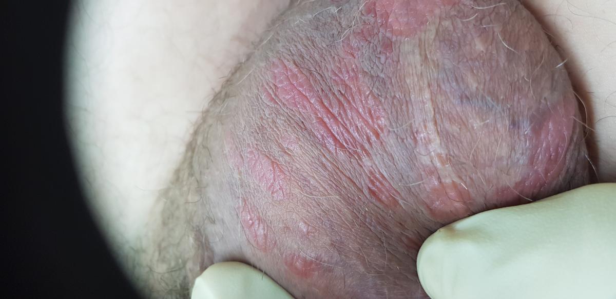 результаты лечения