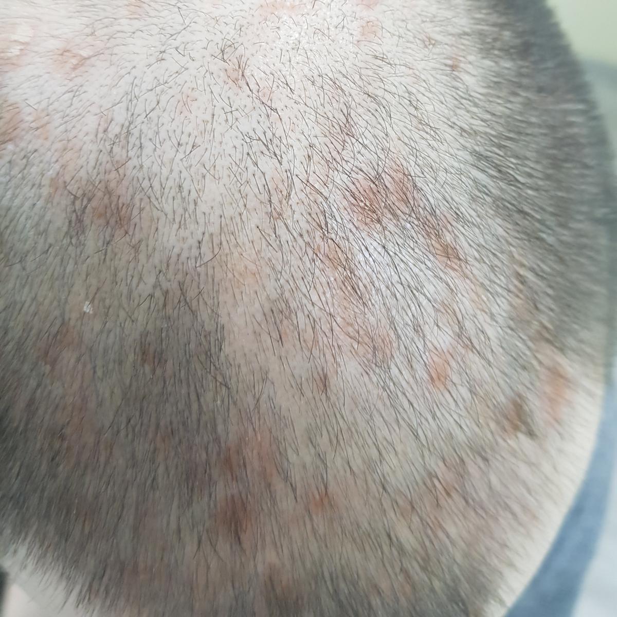 облысение при сифилисе